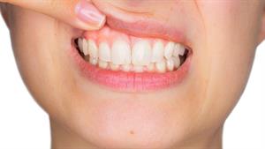 درمان عفونت لثه و دندان 