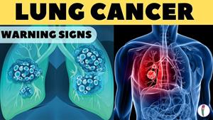 علائم سرطان ریه چیست 