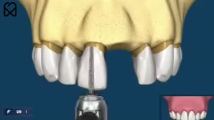 مقایسه بریج دندان با ایمپلنت