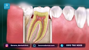 چگونه کیست ریشه دندان باعث دندان درد می شود؟