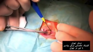 درمان قطعی بواسیر بدون عمل جراحی - درمان تهران