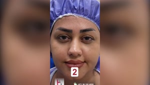 زراعة الحواجب في Helia Clinic: نتائج فورية وجميلة تُحقق الأح