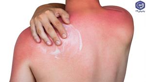 درمان خانگی آفتاب سوختگی و تیرگی پوست