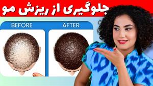درمان ریزش مو برای مردان