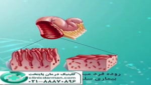 بیماری های گوارشی