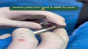 فیلم بازکردن ایمپلنت 