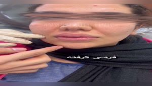 عوارض فاجعه بار فیلر لب 