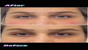 تزریق فیلر زیر چشم 