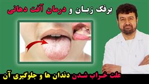 درمان آفت زبان و دهان