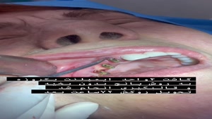 فیلم کاشت دندان در کل دهان با ایمپلنت یک روزه با تحویل روکش 