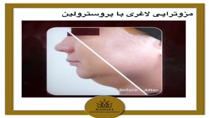 نمونه کار لاغری با مزوتراپی