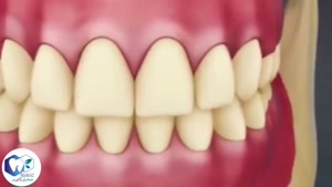 بلیچینگ دندان (سفید کردن دندان)