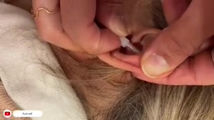 راهکار عالی برای درمان وزوز گوش با طب سوزنی