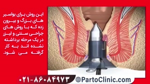 فیلم جراحی هموروئید با استاپلر - partoclinic.com