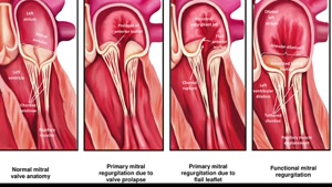 درمان افتادگی دریچه میترال و تقویت قلب