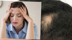 موثرترین راهکار برای درمان ریزش موی سکه ای