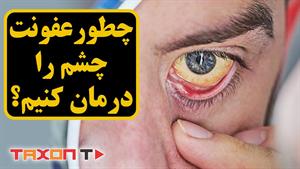درمان سریع عفونت چشم
