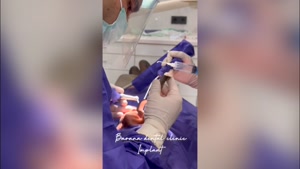 نحوه ایمپلنت دندان در کلینیک دندان پزشکی بارانا