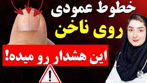 چه چیزی باعث خطوط عمودی روی ناخن ها میشه؟!