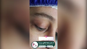 تغییری شگفت‌انگیز با کاشت ابرو