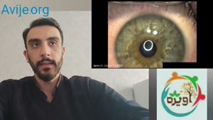 معافیت دائم سربازی برای بیماری قوز قرنیه