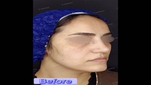 کشیدن و تزریق چربی با استفاده از دستگاه Lipo Modeling