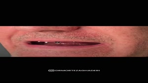 ایمپلنت کل دهان در تهران 