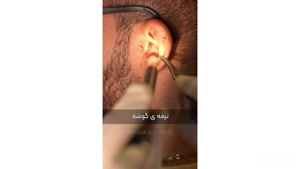 اندوسکوپی در امیقا 