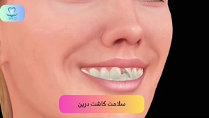 ایمپلنت دندان برای دندان‌های جلویی شکسته | سلامت کاشت درین