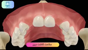 خوردگی کامل دو دندان شماره ۲ از دست رفته | سلامت کاشت درین