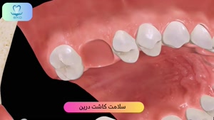 کاشت ایمپلنت دندان برای فک بالا | سلامت کاشت درین