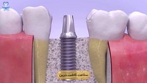 روش‌های کاشت ایمپلنت دندان | سلامت کاشت درین