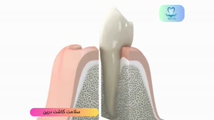 معرفی سیستم ایمپلنت دندانی | ایمپلنت دندان چیست؟ | سلامت کاش