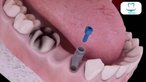 روکش دندان و ایمپلنت ترکیبی | سلامت کاشت درین