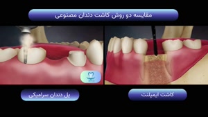 مقایسه پل دندان سرامیکی و ایمپلنت دندانی | سلامت کاشت درین