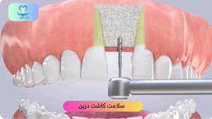 کاشت ایمپلنت برای دندان جلو |سلامت کاشت درین