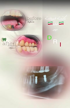 انواع ایمپلنت ایرانی و قیمت انها را بدانید 