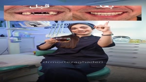 ایمپلنت اقساطی تهران