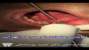 ایمپلنت تخصصی پیچی در کلینیک دکتر حمید پورصادقی