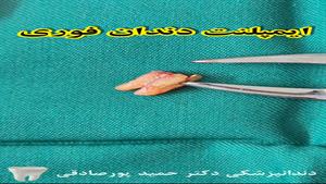 کاشت دندان تخصصی در کلینیک دکتر حمید پورصادقی