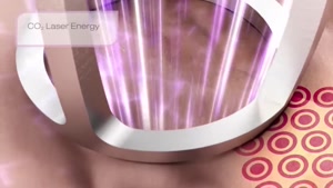 نحوه  جوانسازی پوست با لیزر فرکشنال