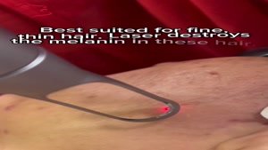 نحوه رفع موهای نازک با لیزر کیوسوئیچ