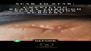 قبل و بعد لیزر جای زخم