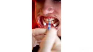 گریلز دندان