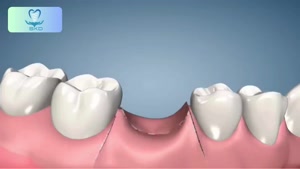 ایمپلنت دندان را با یک عمل جراحی میتوان کامل کرد؟|سلامت کاشت