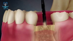 کاشت ایمپلنت - بازگرداندن کامل عملکرد دندان از دست رفته | سل