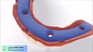 ایمپلنت کامل فک به روش All-On-4 | سلامت کاشت درین 3A