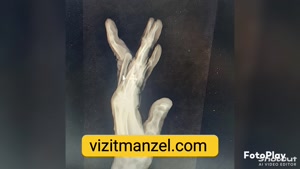 درمان شکستگی انگشت توسط دکتر خنجری