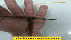 خارج کردن جسم خارجی توسط دکتر ثمربخش