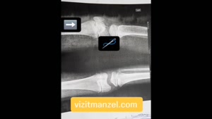 خارج کردن جسم خارجی توسط دکتر شاهدی